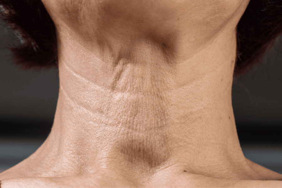 Vùng cổ thường chịu tác động nặng nề hơn do đặc điểm cấu trúc nên dễ lão hóa hơn các vùng da khác