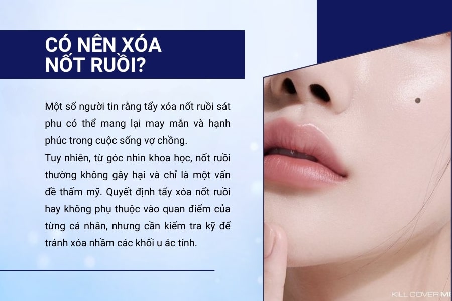 Có nên tẩy xóa nốt ruồi sát phu hay không?