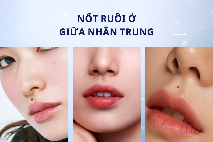 Nốt ruồi giữa nhân trung - Nam nữ đều gặp trắc trở