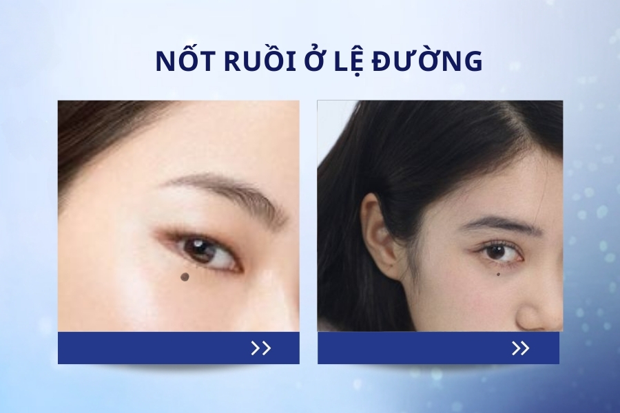 Nốt ruồi ở lệ đường - Nốt ruồi đón lệ, khổ sở tình duyên