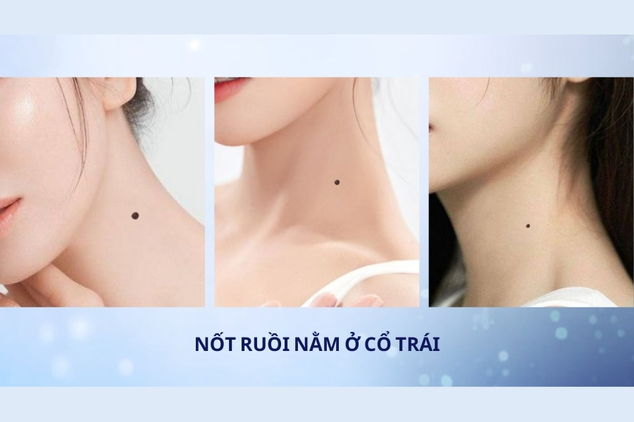 Nốt ruồi ở cổ - Mệnh tương đối vất vả vì gia đình