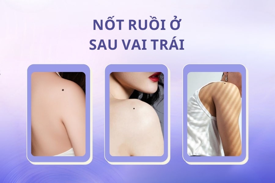 Nốt ruồi ở sau vai trái - Nốt ruồi gánh nặng