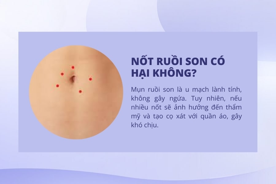 Nốt ruồi son có hại không?