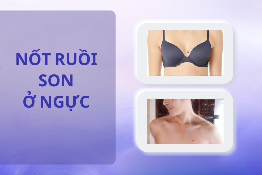 Nốt ruồi son ở ngực - Nốt ruồi hiếm có, khó tìm