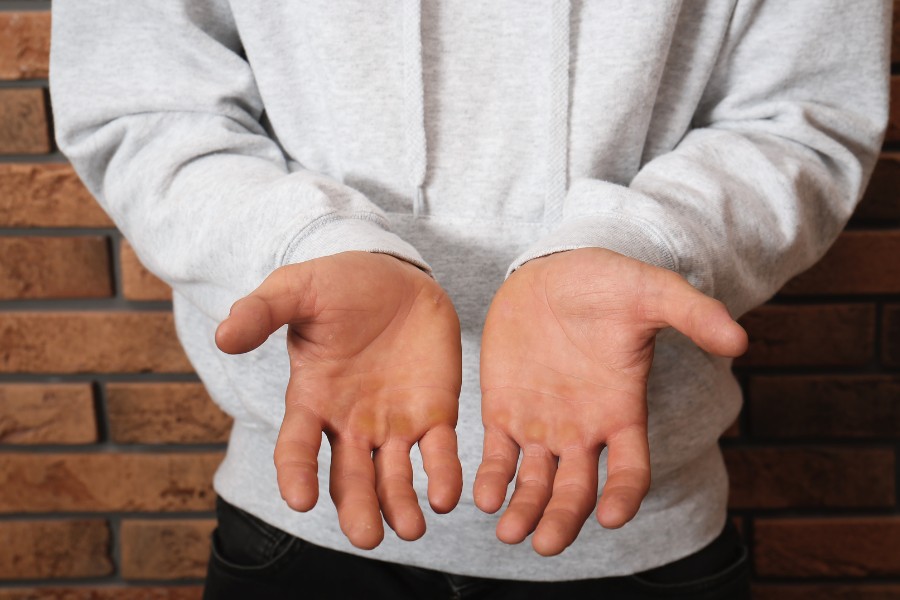 Chai tay là tình trạng bàn tay và các đầu ngón tay trở nên dày và hóa sừng