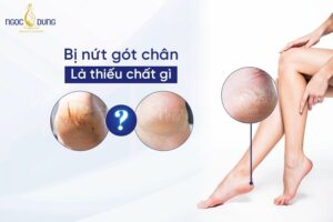 Bị nứt gót chân là thiếu chất gì? Hãy cùng chuyên gia tại Ngọc Dung Beauty tìm hiểu ngay