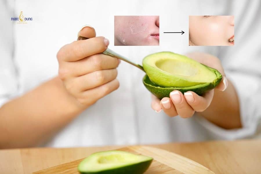 Bơ có thể hỗ trợ làm mềm vùng da khô nhờ chất béo tốt, vitamin E và một số chất chống oxy hóa