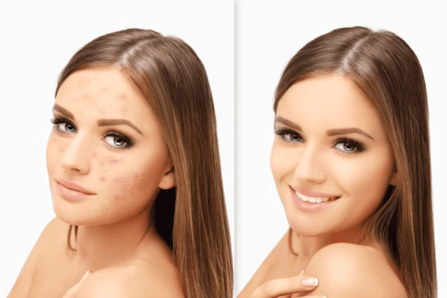 Bơ giúp hỗ trợ điều trị mụn và kháng viêm cho da 
