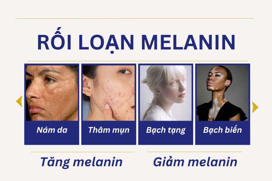 Rối loạn hắc sắc tố Melanin có thể gây ra nhiều bệnh lý về da
