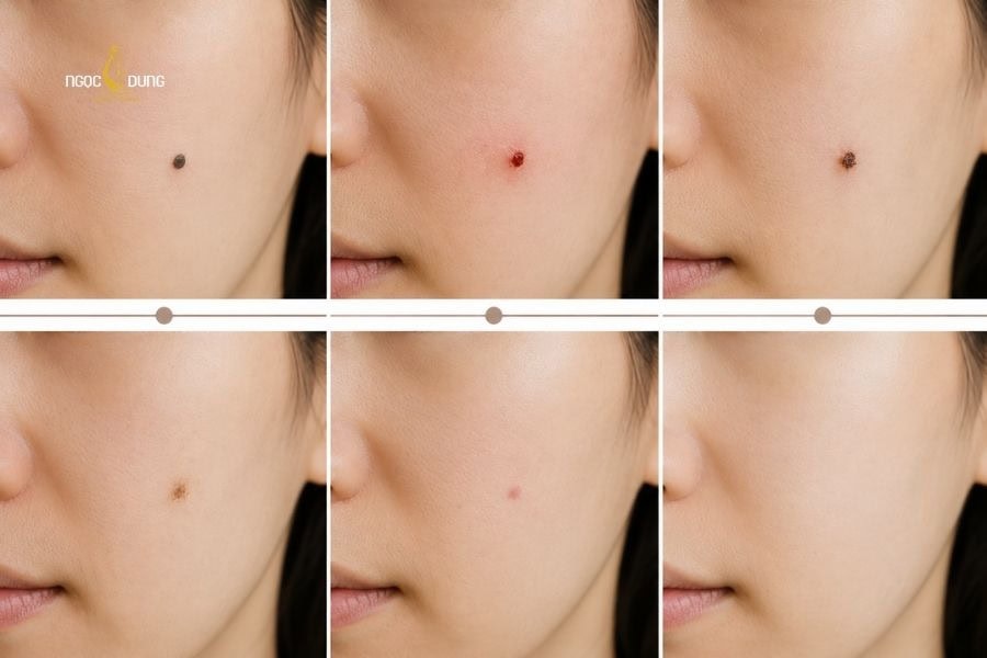 Quá trình phục hồi da sau khi tẩy nốt ruồi