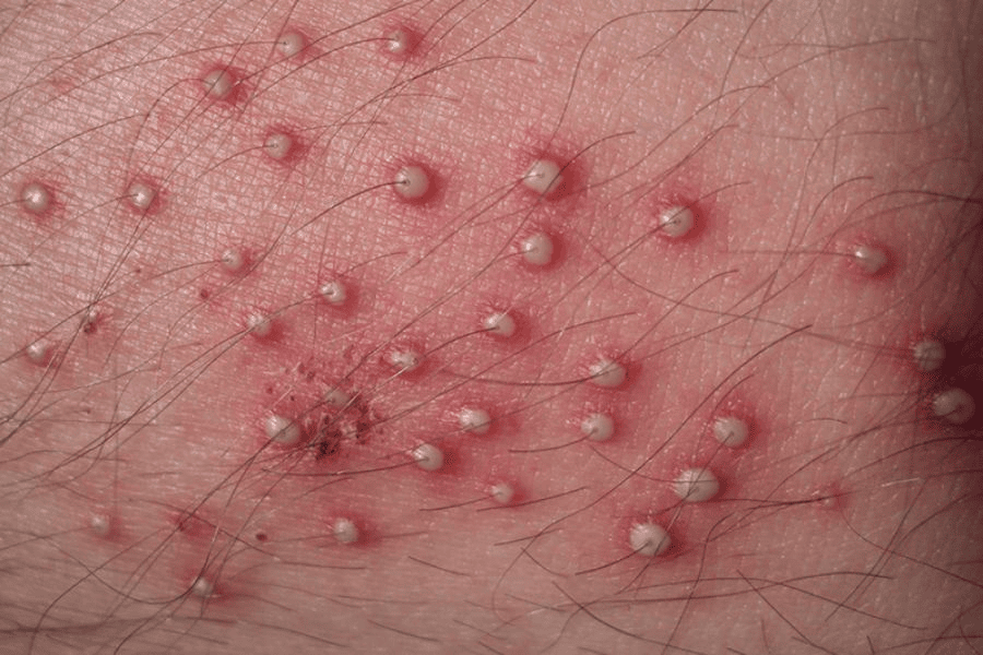 Viêm nang lông vùng kín: Nguyên nhân, dấu hiệu và cách xử lý 7 Các triệu chứng khi bị viêm nang lông vùng kín