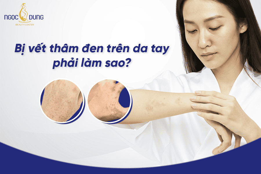 Vết thâm đen da tay là bệnh gì? Nguyên nhân và cách trị 2 Cách điều trị thâm đen trên da tay hiệu quả và an toàn