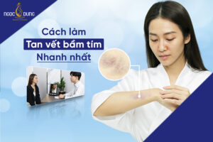 cach lam tan vet bam tim nhanh nhat
