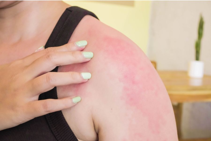 Các dấu hiệu dị ứng da phổ biến bao gồm da bị ngứa ngáy, mẩn đỏ, nổi mụn nước