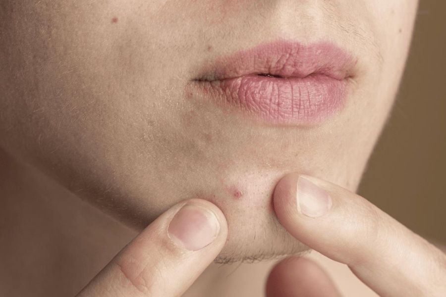 Mụn ẩn dưới cằm xuất hiện do tiếp xúc với vi khuẩn từ bên ngoài