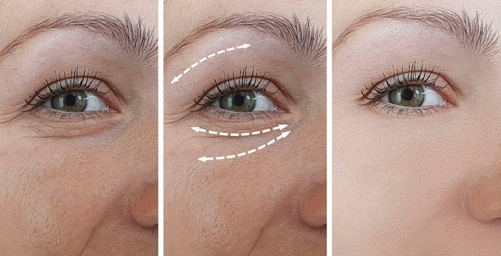 Căng chỉ sinh học giúp nâng đỡ vùng mắt hiệu quả