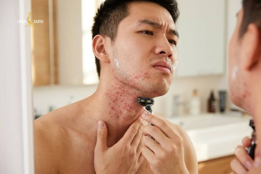 Cạo ngược chiều râu mọc dễ gây ra tình trạng viêm nang lông