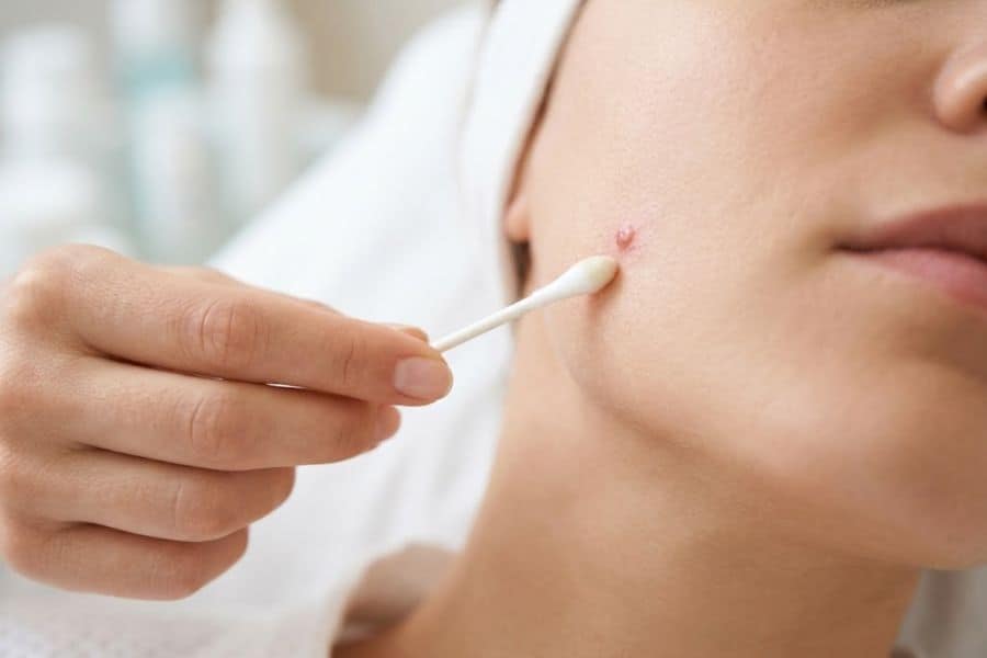 Tẩy nốt ruồi kiêng gì để da nhanh hồi phục, không sẹo? 12 Vệ sinh vết thương bằng nước muối sinh lý Natri Clorid 0.9% giúp loại bỏ vi khuẩn