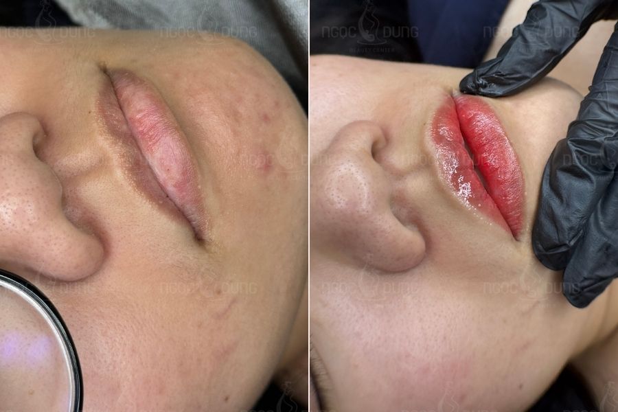 Tình trạng thâm môi sẽ ảnh hưởng đến thời gian lên màu sau khi khử thâm