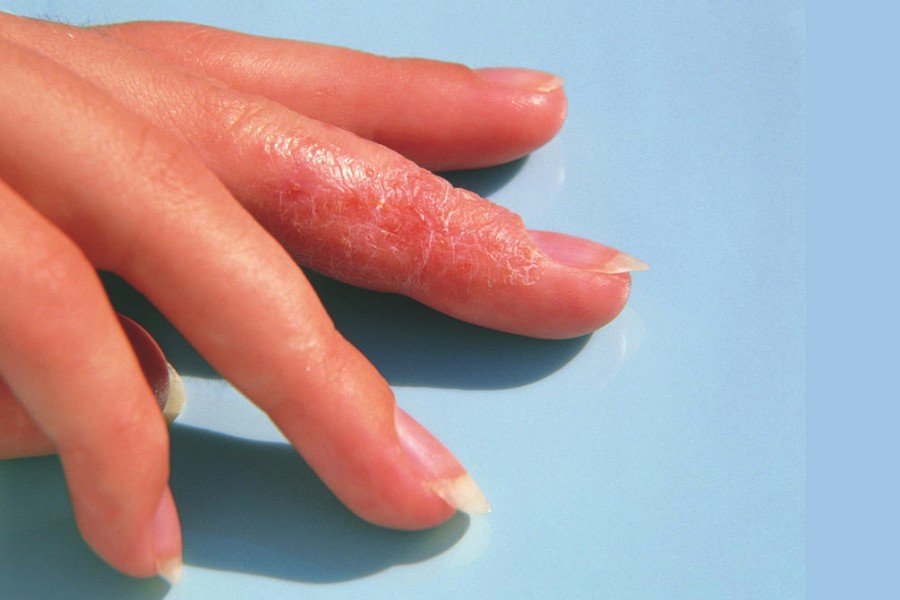 Bệnh chàm da cũng có thể là một trong những nguyên nhân phổ biến khiến đầu ngón tay bị tróc da