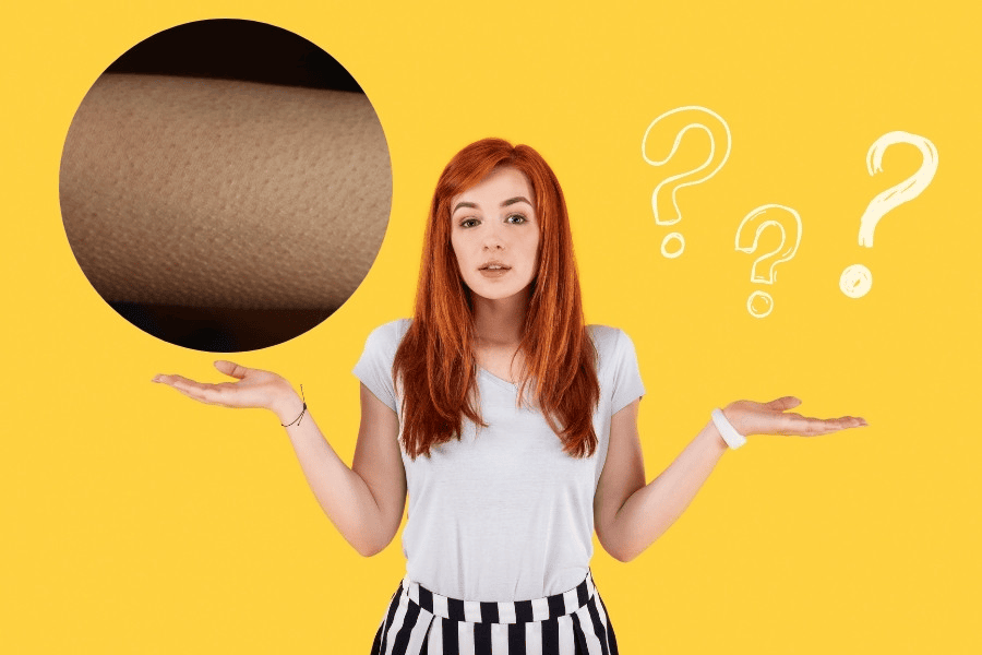 Da nổi sần như da gà không ảnh hưởng tới sức khỏe nhưng ảnh hưởng tới thẩm mỹ và chất lượng cuộc sống 