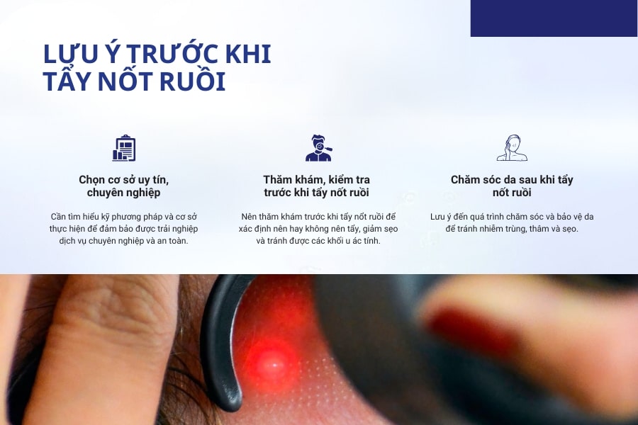 Cần lưu ý gì trước khi tẩy nốt ruồi?