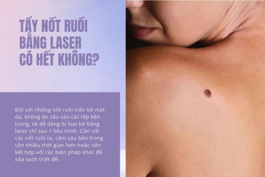 Xóa nốt ruồi bằng laser có hết vĩnh viễn không phụ thuộc vào cơ sở thẩm mỹ mà bạn lựa chọn có uy tín không?