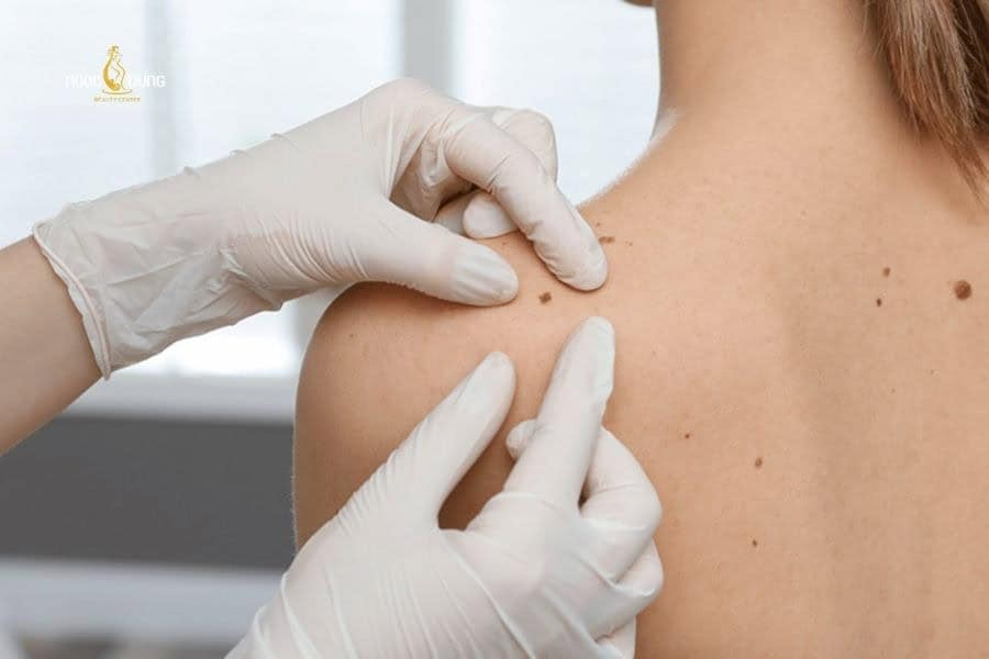 Tùy phương pháp tẩy nốt ruồi mà khách hàng phải trả chi phí khác nhau