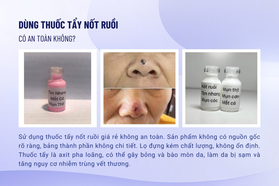 Sử dụng kem tẩy hoặc thuốc tẩy nốt ruồi có đảm bảo an toàn không?