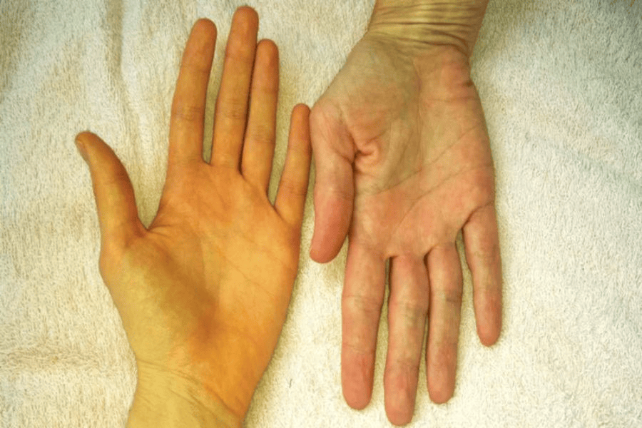 Khi cơ thể thiếu máu sẽ khiến da trở nên xanh xao và ngả vàng