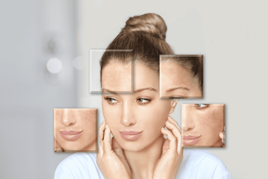 10 tác hại của lăn kim da mặt và cách phòng tránh tối ưu 6 Khi da bị tổn thương quá mức hoặc tiếp xúc trực tiếp với tia UV sau lăn kim sẽ để lại thâm nám