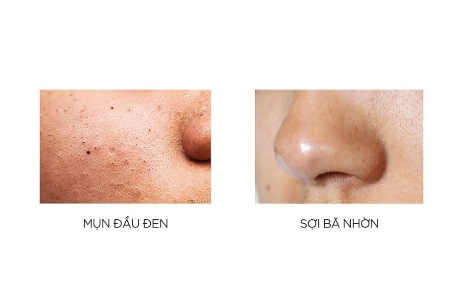 Mụn đầu đen có kích thước không đồng đều