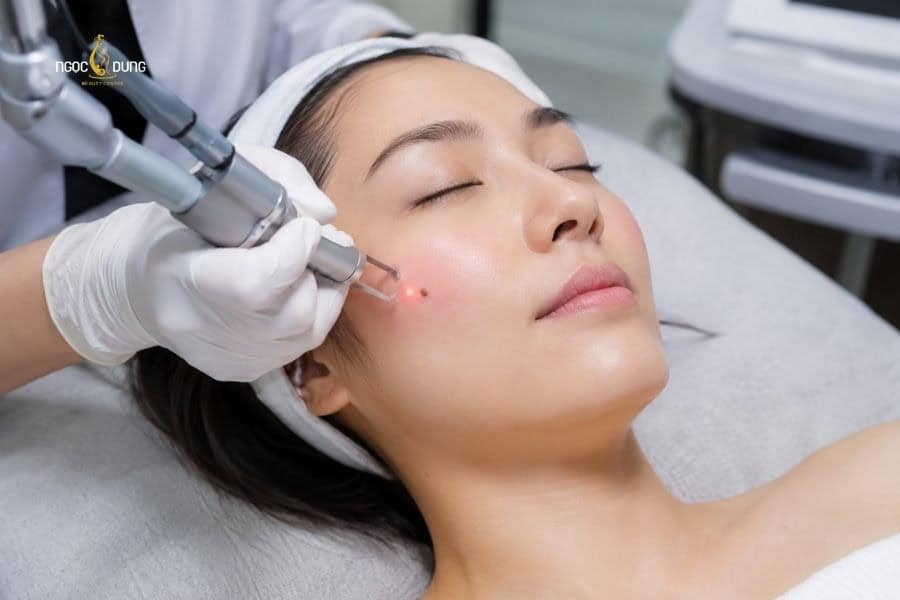 Laser là một trong những công nghệ xóa nốt ruồi an toàn và hiệu quả nhất hiện nay