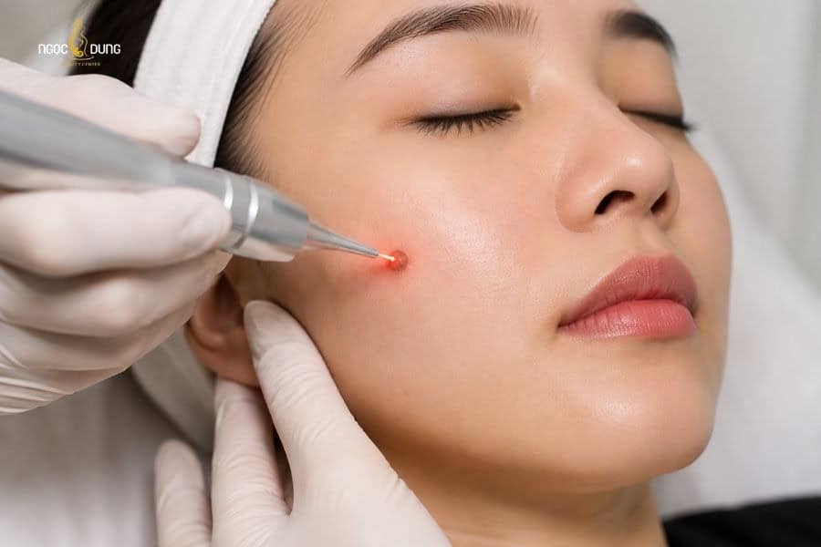 Laser là một trong những giải pháp tẩy nốt ruồi hiệu quả và an toàn nhất hiện nay