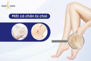 Tổng hợp các cách trị mắt cá chân bị chai sần có thể thực hiện đơn giản tại nhà