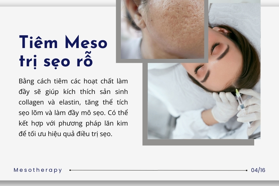 Trị sẹo rỗ bằng phương pháp Meso