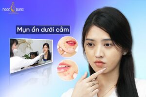 Bật mí các cách điều trị mụn ẩn dưới cằm cực hay cho chị em