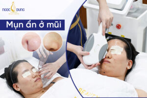 Mụn ẩn ở mũi: Nguyên nhân, dấu hiệu và các cách điều trị