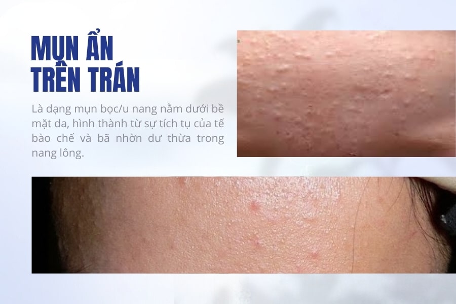 Bị nổi mụn ẩn trên trán là gì?