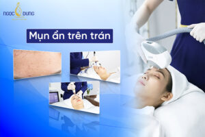 Mụn ẩn trên trán: Nguyên nhân, dấu hiệu và cách trị hiệu quả