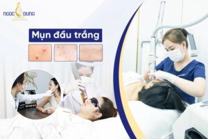 Mụn đầu trắng là gì? Mụn đầu trắng có tự hết không? Hãy cùng TMV Ngọc Dung tìm hiểu ngay