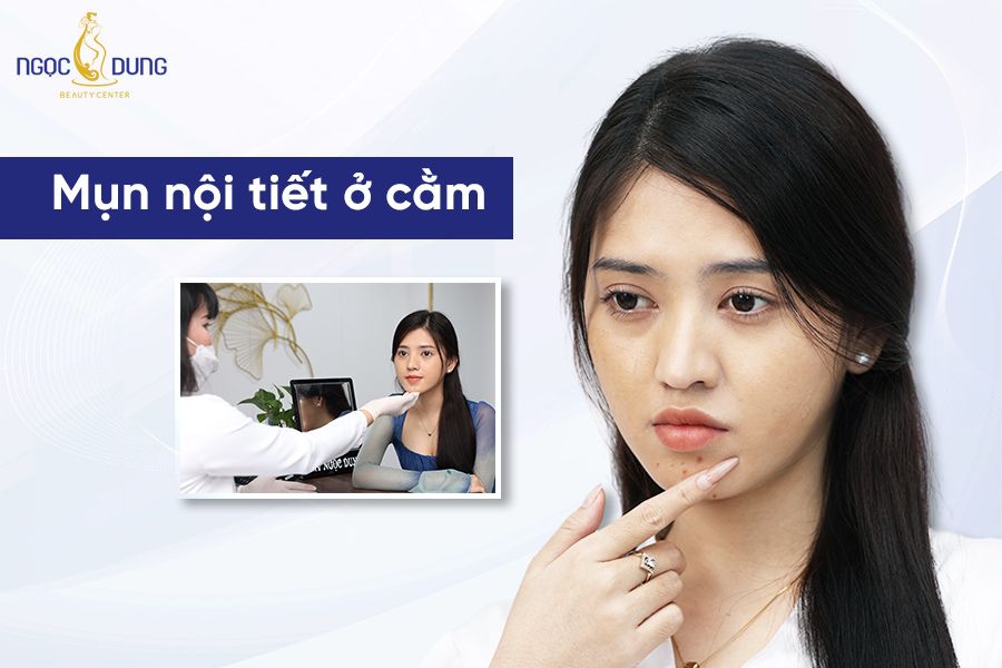 Mụn nội tiết ở cằm là gì? Trị mụn nội tiết ở cằm có khó không? Cùng chuyên gia giải đáp ngay