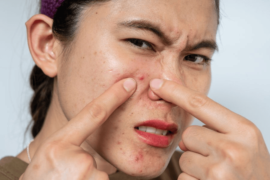 Nặn mụn sai cách khiến da tổn thương và để lại thâm mụn 