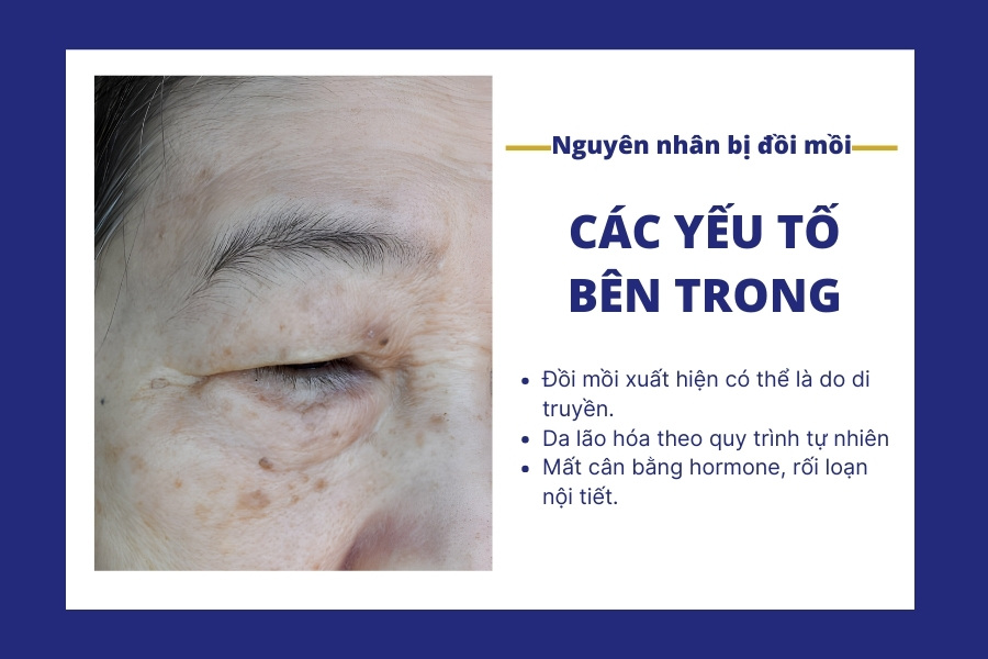 Tình trạng mất cân bằng hormone, rối loạn nội tiết ở phụ nữ mang thai và tiền mãn kinh là nguyên nhân gây đồi mồi