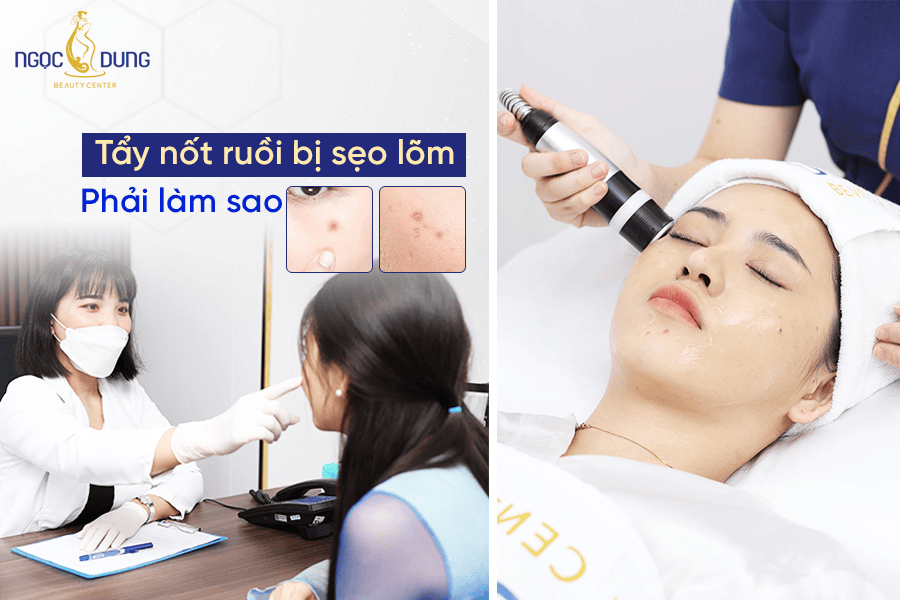 Nguyên nhân bị sẹo lõm ngay sau tẩy nốt ruồi
