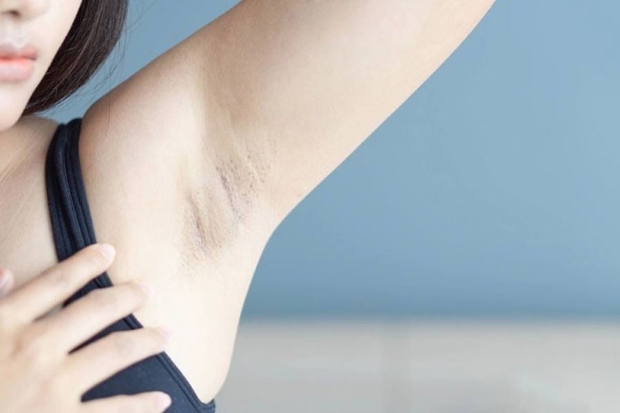 Lông nách mọc đôi có sao không? Cách xử lý và ngăn ngừa hiệu quả 4 Lông nách mọc đôi có thể xuất phát từ cơ địa, cấu trúc nang lông, thói quen triệt lông