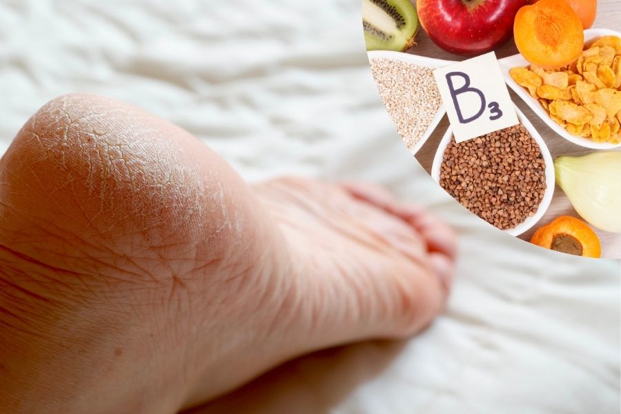 Bị nứt gót chân là thiếu chất gì? Phần lớn nguyên nhân gây nứt gót chân là do thiếu vitamin B3