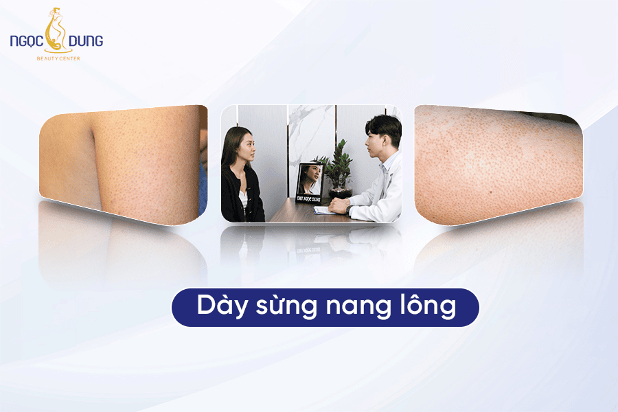 Nguyên nhân, triệu chứng và cách điều trị dày sừng nang lông hiệu quả