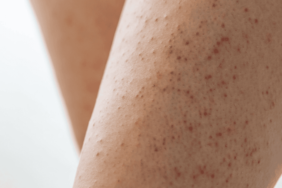 Những nguyên nhân dẫn đến dày sừng nang lông thường gặp