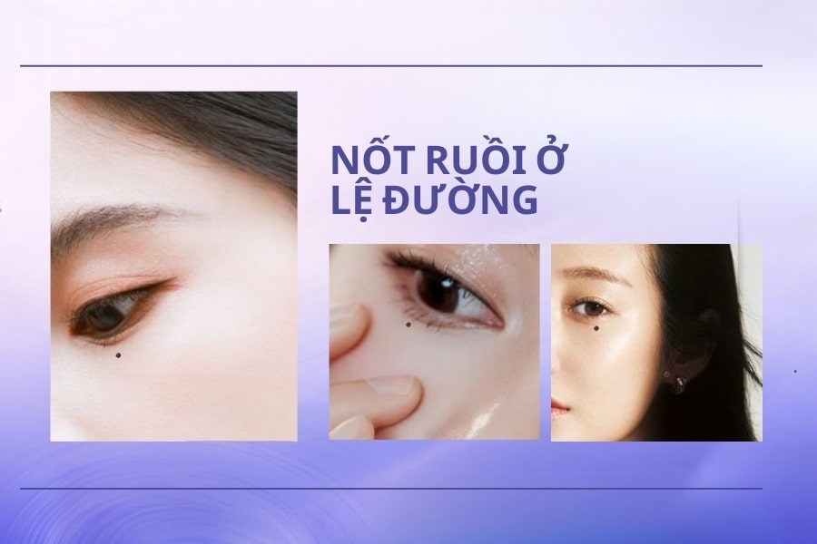 Nốt ruồi ở lệ đường - Nốt ruồi khổ sở vì tình